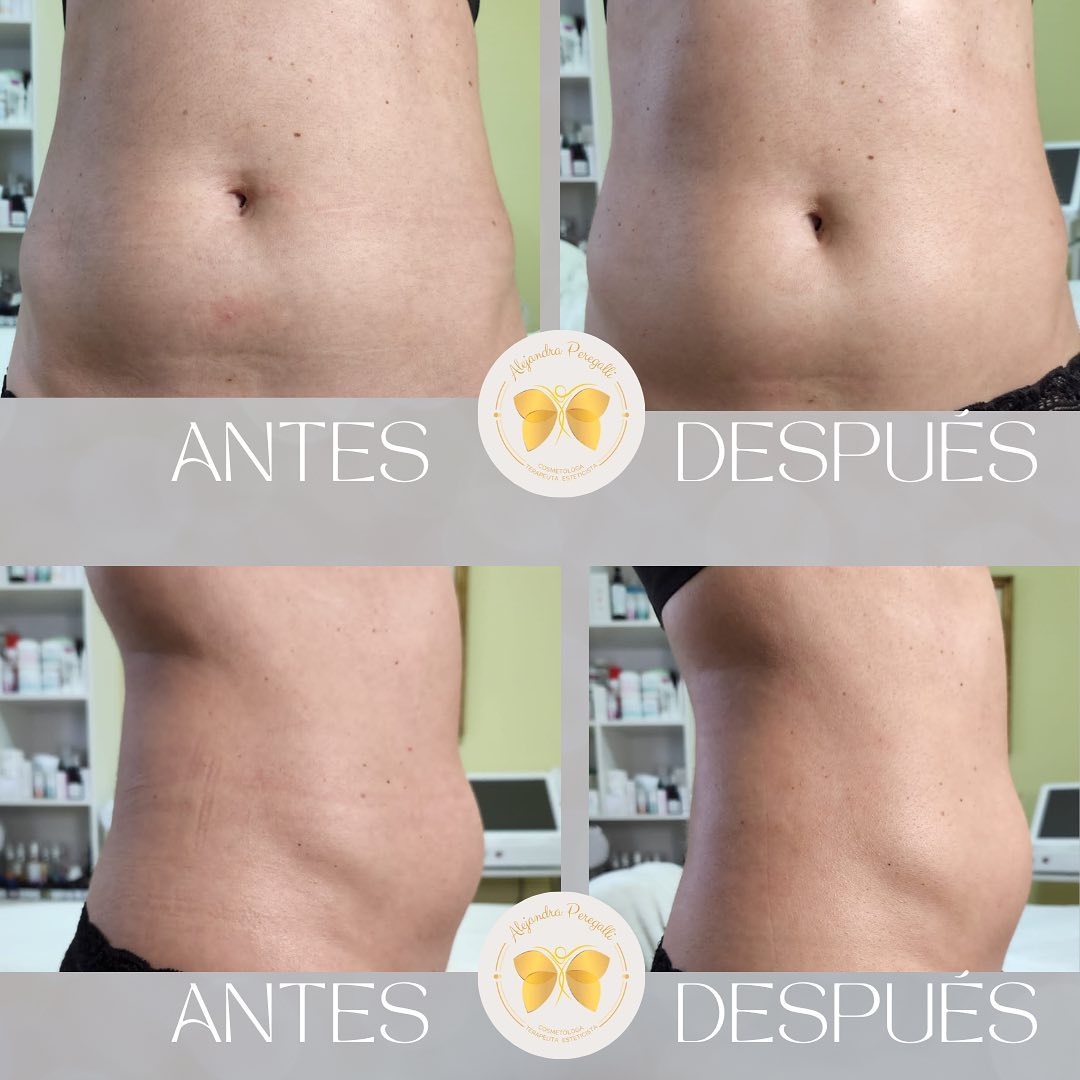 Abdomen antes y después, de frente y de perfil, en una tarjeta de resultados del centro